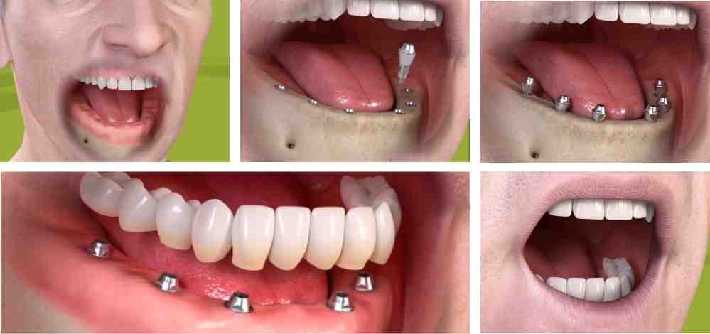 Can 1 implant replace 2 teeth?