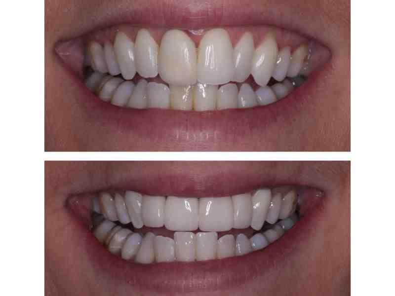 Can a chipped tooth get infected?