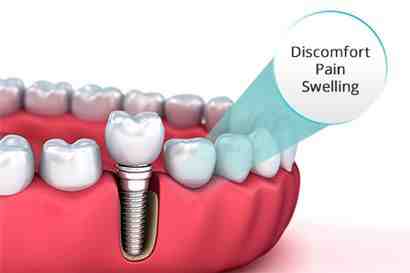 Can your body reject dental implants years later?