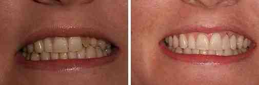 Do I need to go to the dentist for a small chip in my tooth?