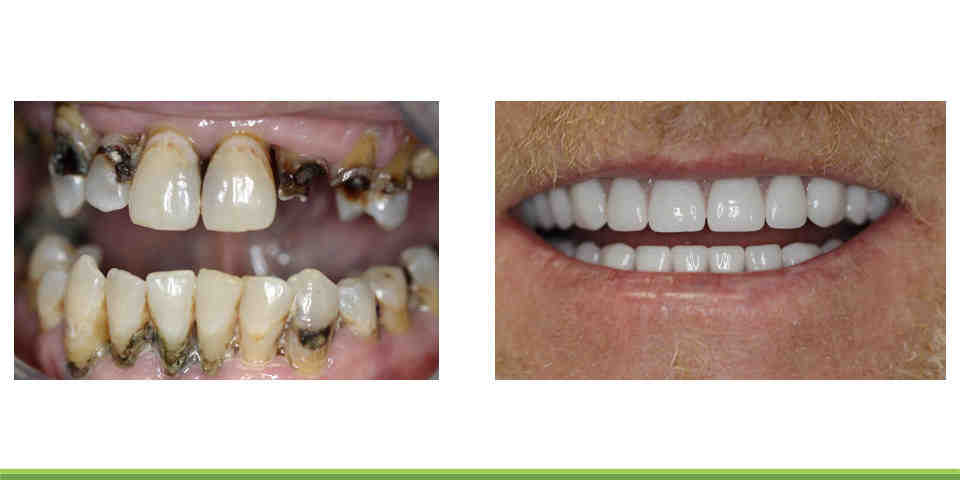 Do dentures shorten your life?