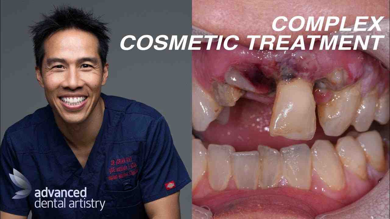 Do you have to shave your teeth for veneers?