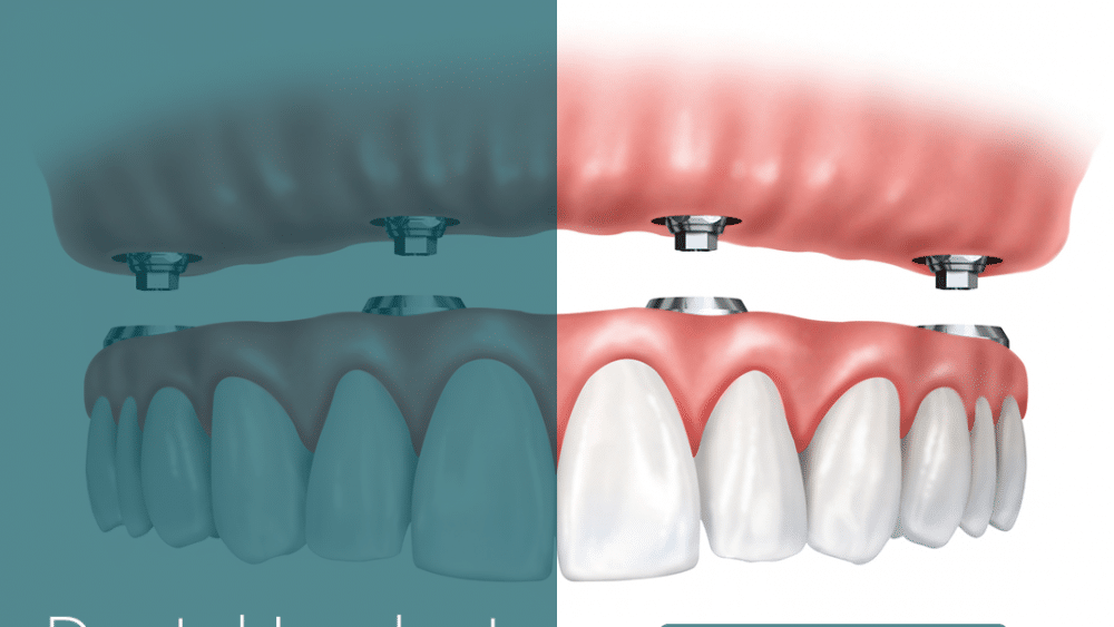 How can I fix my teeth with no money?