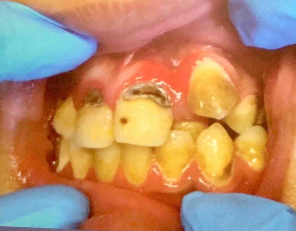 What does a rotten tooth look like? Best of Indianapolis