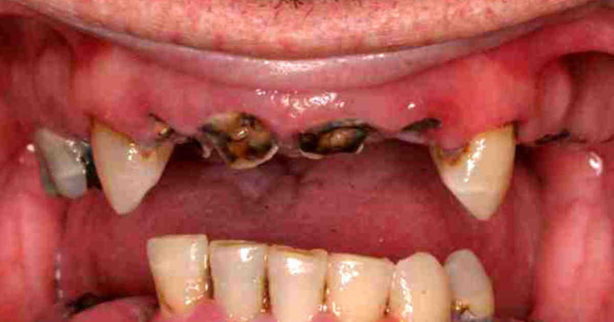 How do you stop a rotten tooth from hurting?