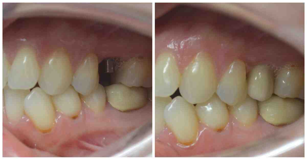 How much do molar implants cost?