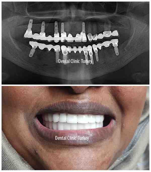How much would 6 implants cost?
