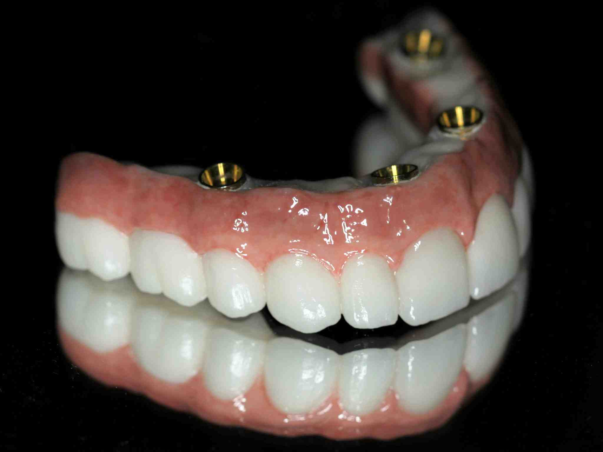 What are the disadvantages of tooth implant?