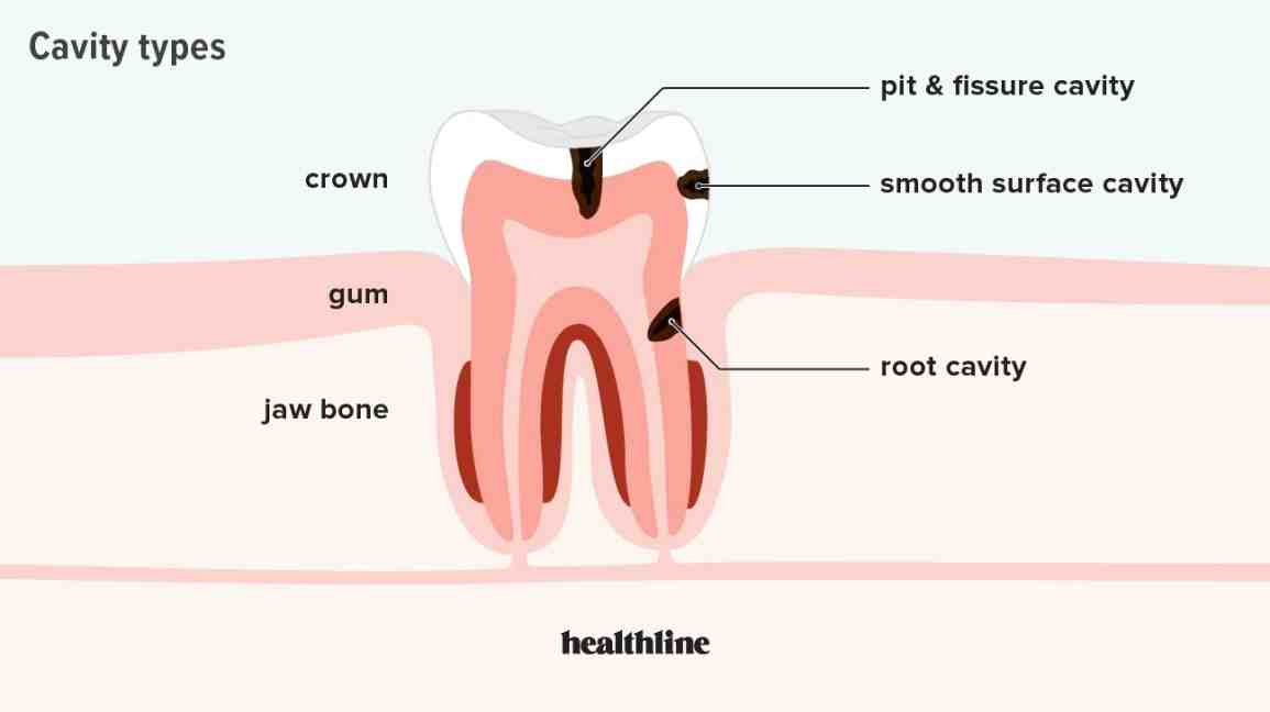 What happens if you don't get a rotten tooth pulled?