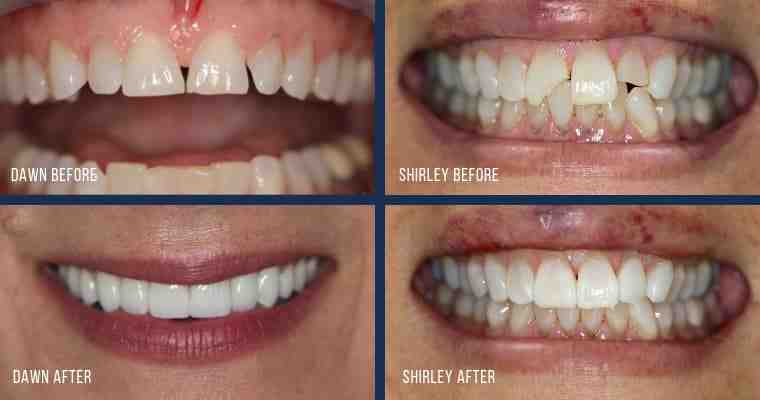 What type of dentures are the best?