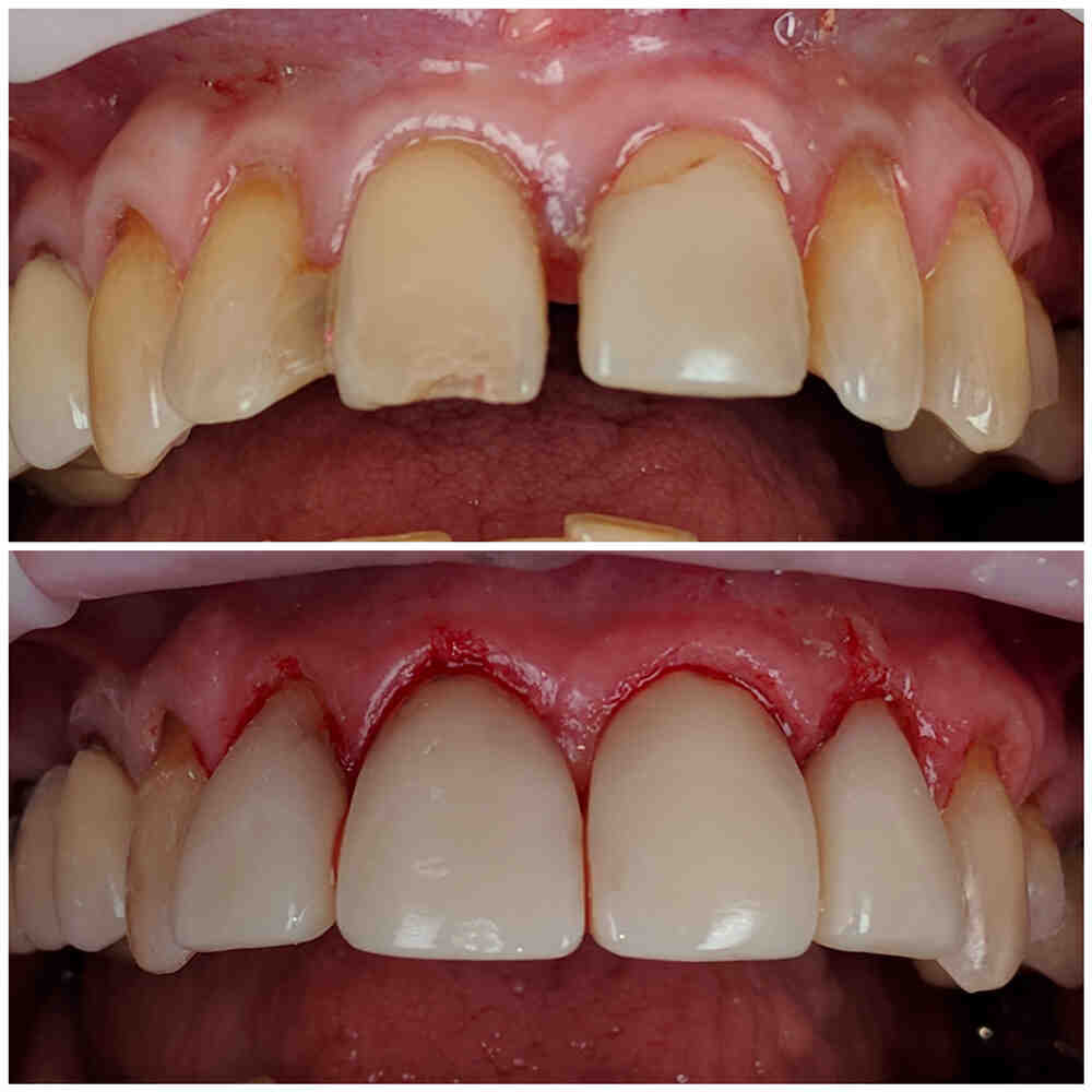 Will a chipped tooth get worse?