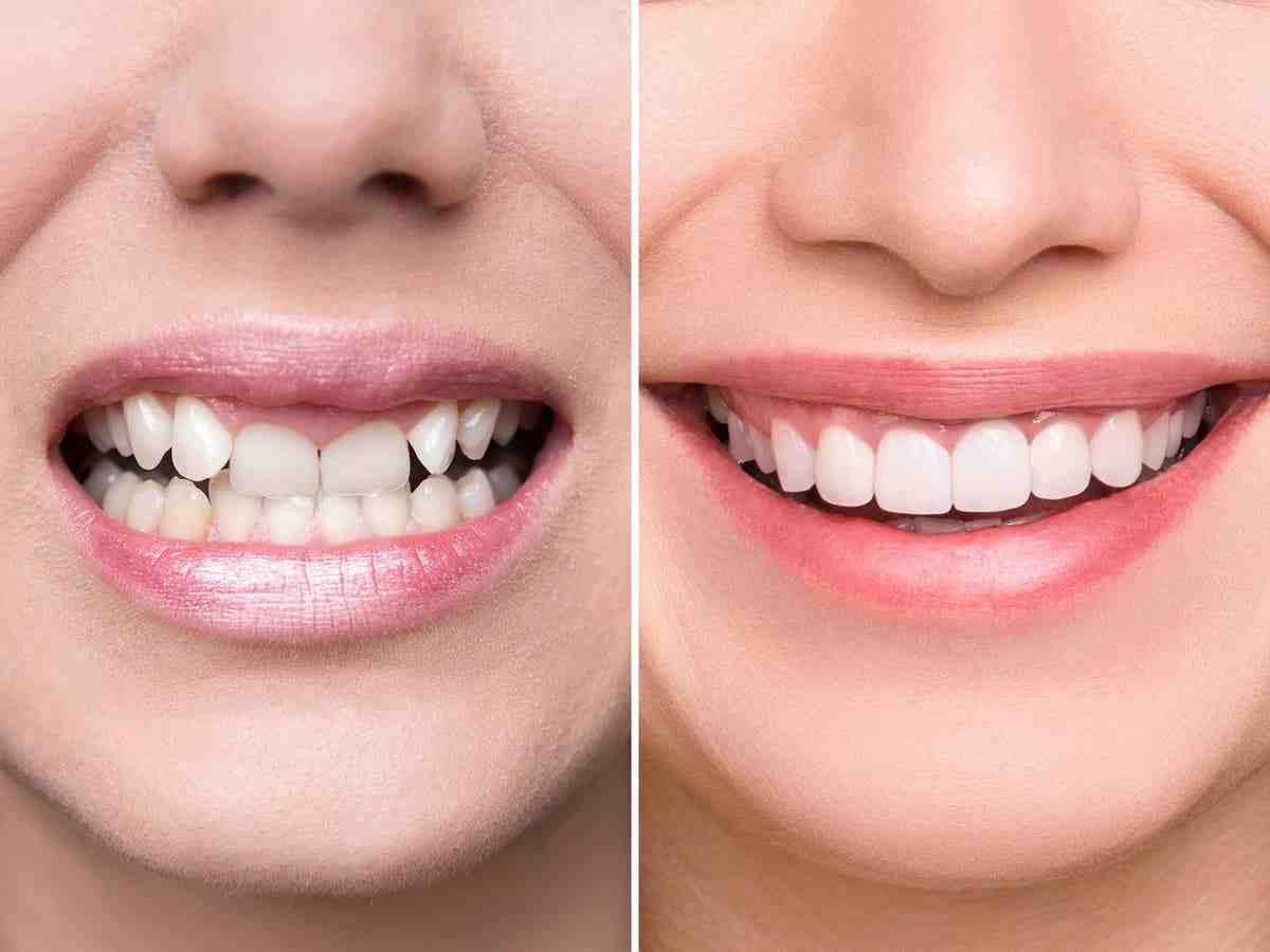 Will a rotten tooth eventually fall out?
