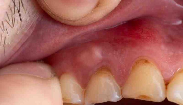 Can a dentist pull an infected tooth?