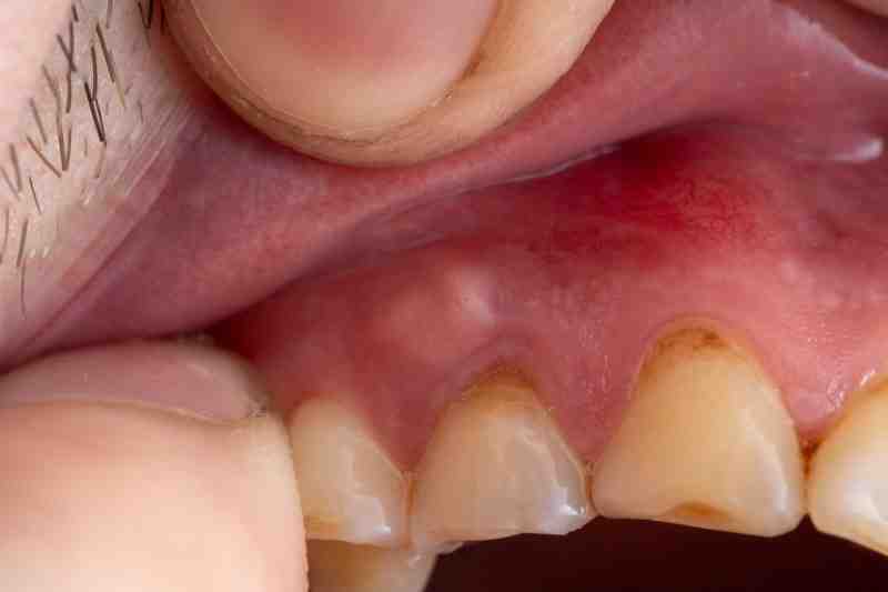 Can a dentist pull an infected tooth?