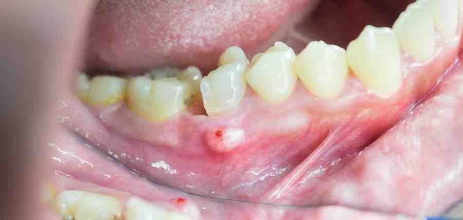 Can tooth infections spread?