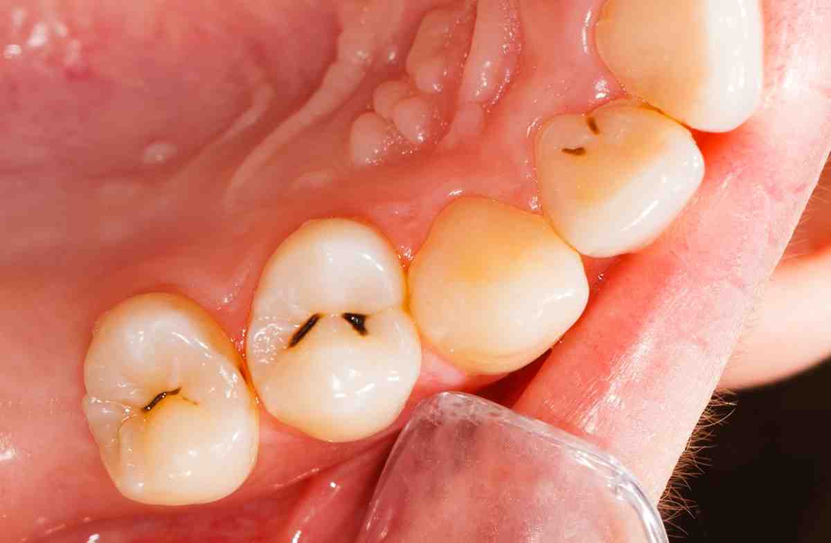 How fast can a tooth infection spread?