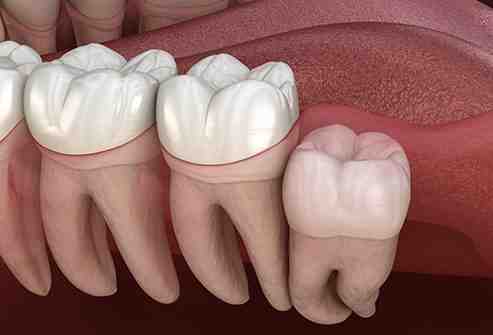 What happens if a decayed tooth is not removed?